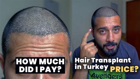 Cost of hair transplant in turkey with blue magic hair